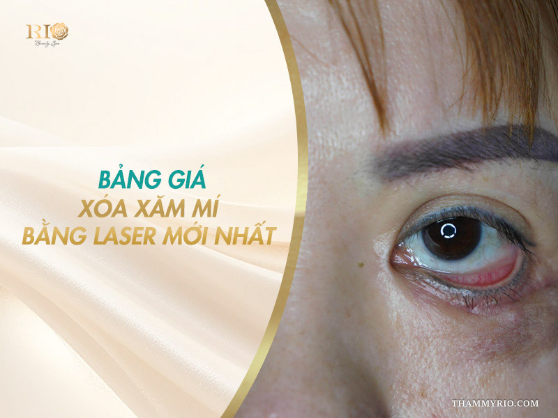 Cận cảnh vùng viền mí mắt bị trổ mực loang màu trên banner bảng giá xóa xăm mí bằng laser mới nhất