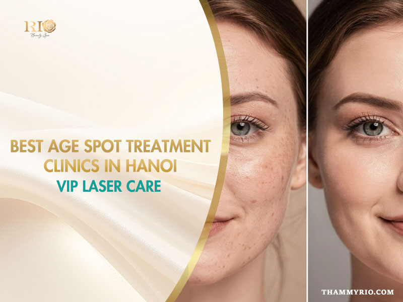 Best age spot treatment clinic in Hanoi featuring advanced vip laser care