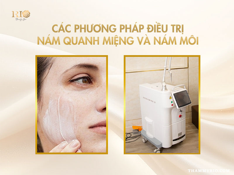 Các phương pháp y khoa điều trị hiệu quả khi bị nám quanh miệng.