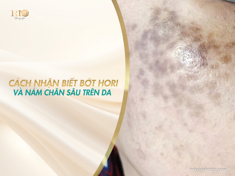 Cận cảnh vùng da gò má bị các đốm hắc tố màu xám xanh tích tụ trên banner hướng dẫn cách nhận biết bớt Hori và nám chân sâu