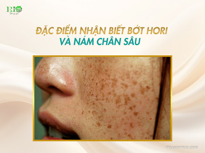 Hình ảnh cận cảnh góc nghiêng vùng gò má và sống mũi phủ đầy đốm nâu xám trên banner đặc điểm nhận biết bớt Hori và nám chân sâu