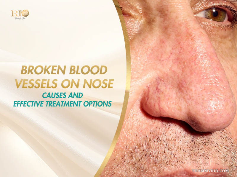 Close-up of prominent nasal telangiectasia on a male client on a banner discussing causes and treatment for broken blood vessels on nose