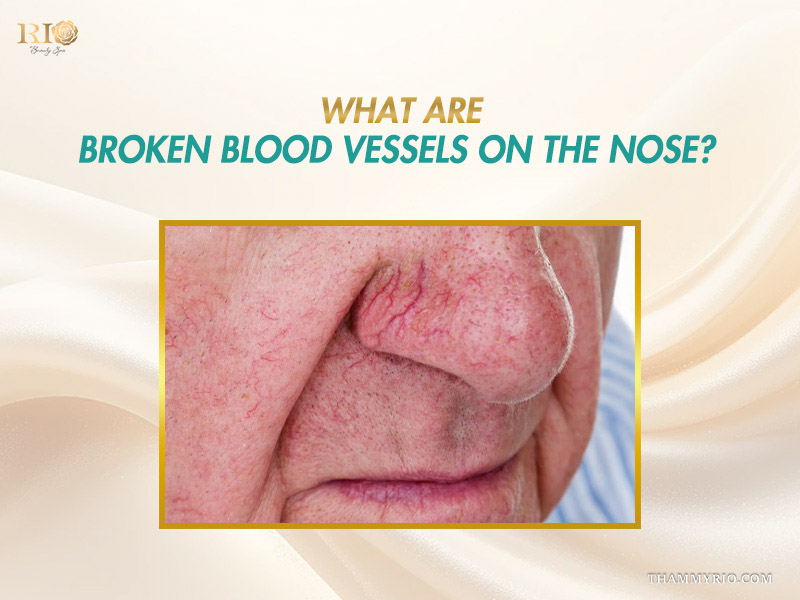 High-detail close-up of branched nasal capillaries explaining what are broken blood vessels on nose