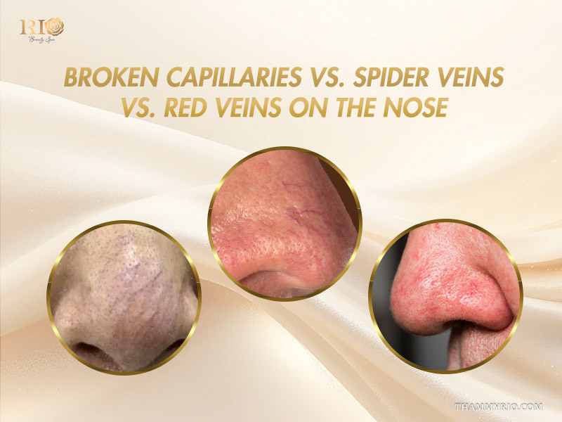 Three circular comparative views distinguishing broken capillaries, spider veins, and red veins on the nose
