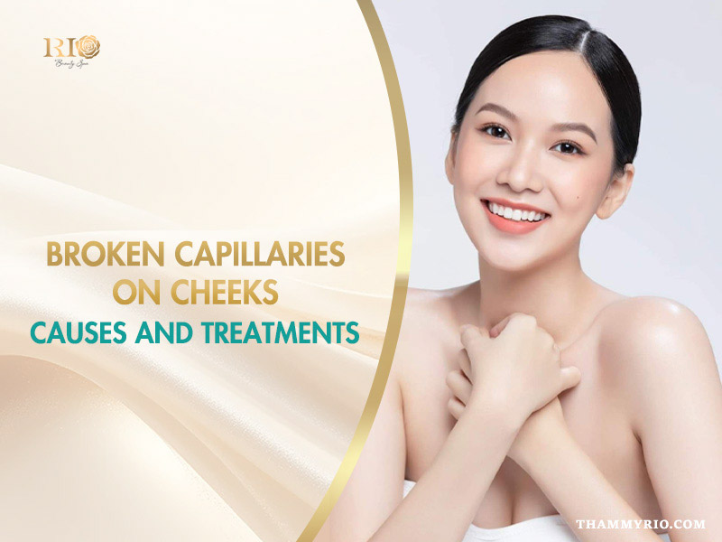 Understanding broken capillaries on cheeks and why they appear chart