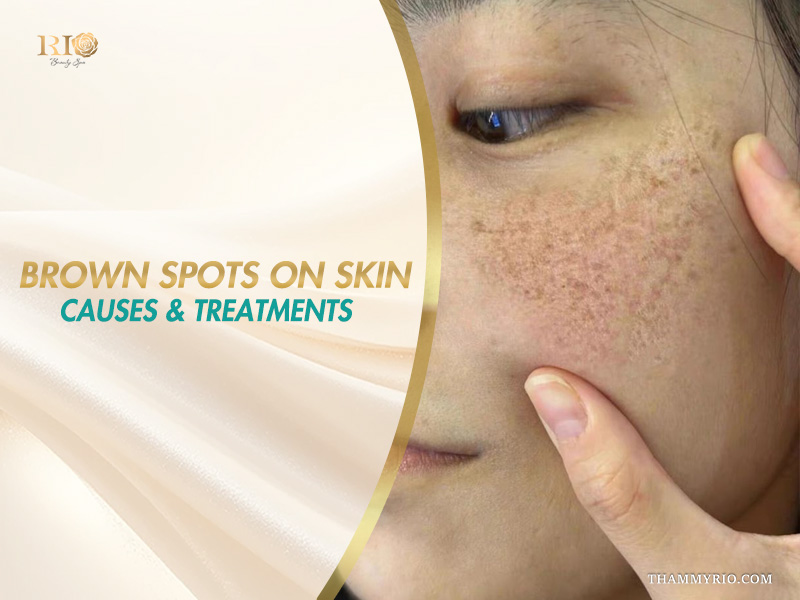 Close-up of a cheek showing dark pigmentation patches on a banner addressing the cause of a brown spot on skin