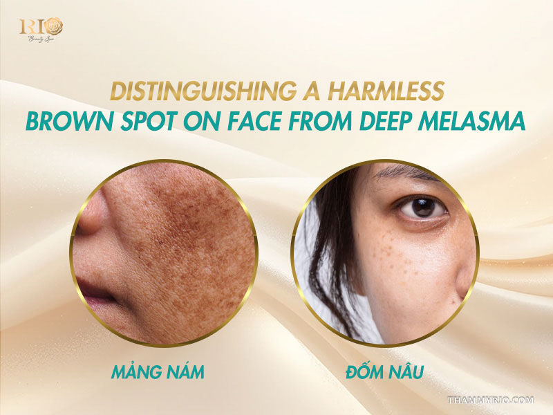 Side-by-side comparison distinguishing widespread melasma patches from a discrete brown spot on skin