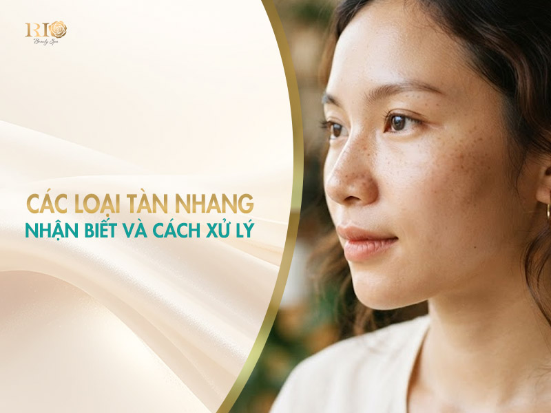 Nhận biết và cách xử lý các loại tàn nhang trên da mặt.