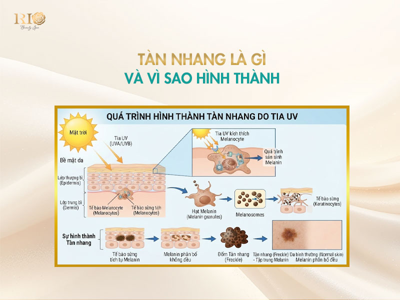 Sơ đồ quá trình tia UV hình thành các loại tàn nhang.
