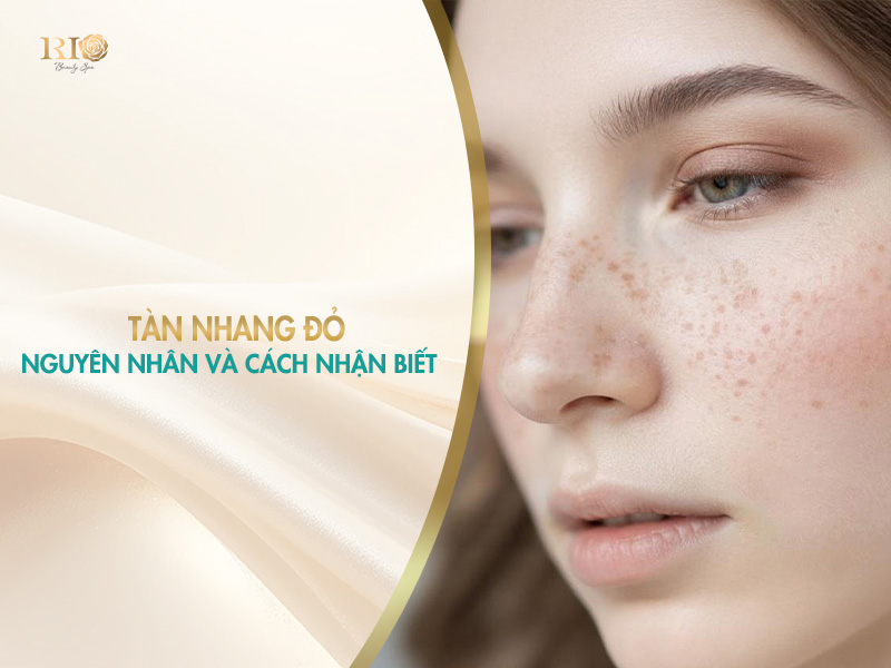 Nhận biết dấu hiệu và nguyên nhân của các loại tàn nhang đỏ.
