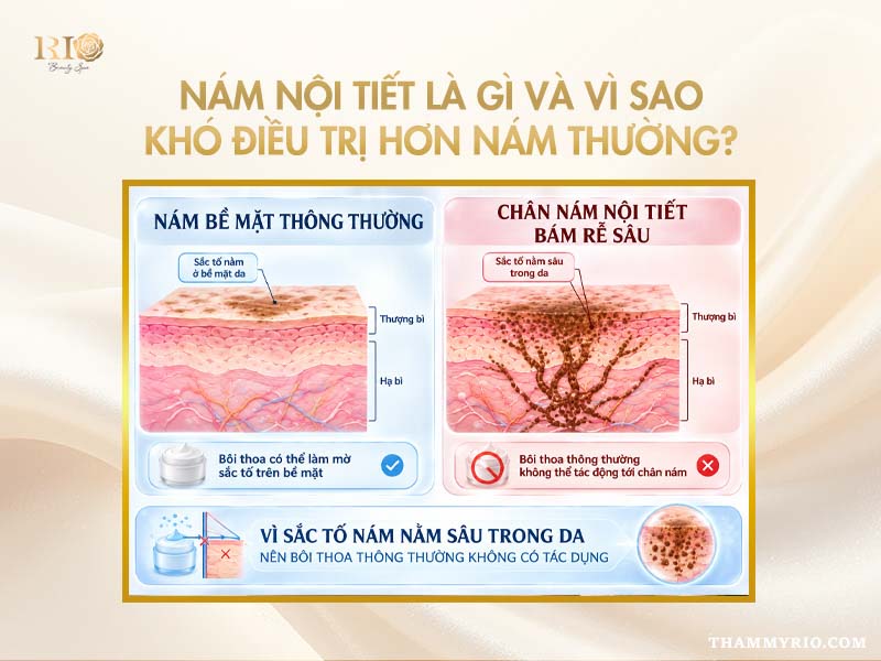Lý do cách điều trị nám nội tiết gặp nhiều khó khăn