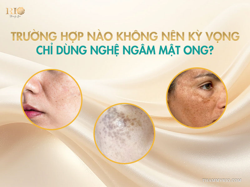 3 hình ảnh minh họa các trường hợp nám chân sâu, nám mảng sẫm màu trên banner phân tích hạn chế của nghệ ngâm mật ong