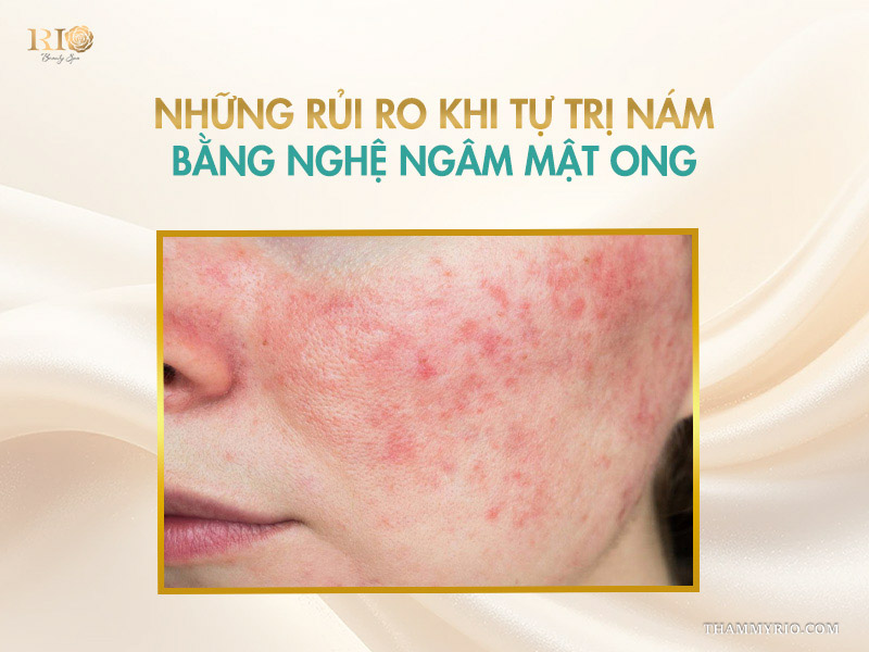 Cận cảnh làn da gò má mẩn đỏ, kích ứng nổi dị ứng trên banner cảnh báo rủi ro khi dùng nghệ ngâm mật ong