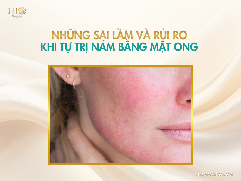 Cận cảnh làn da má bị mẩn đỏ, kích ứng do tự ý áp dụng các phương pháp trị nám bằng mật ong sai cách