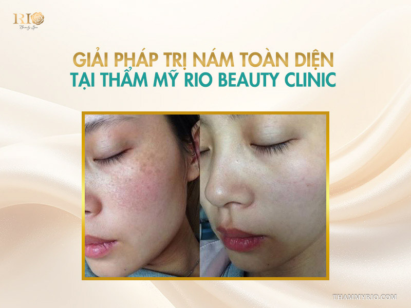 Hình ảnh so sánh trước và sau khi trị nám thành công tại Thẩm mỹ Rio, mảng nám tích tụ được làm mờ rõ rệt