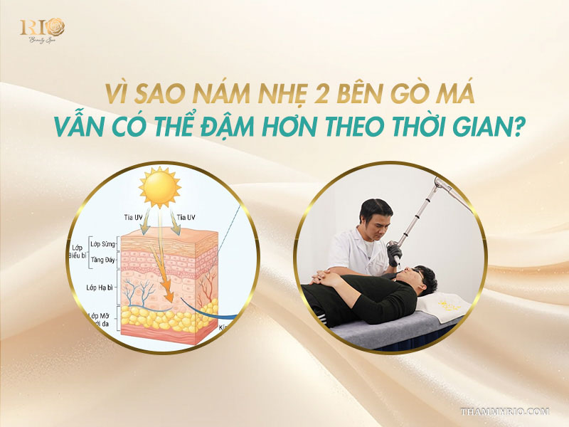 Tia UV làm nám đậm hơn dù đã áp dụng cách trị nám gò má tại nhà.