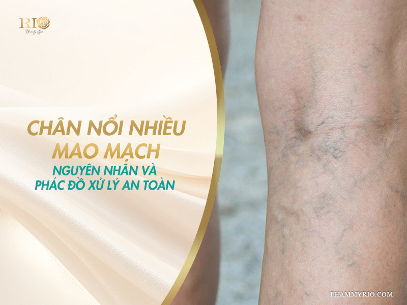 Cận cảnh bắp chân nổi nhiều mao mạch chằng chịt màu tím xanh trên banner tìm hiểu nguyên nhân và phác đồ xử lý