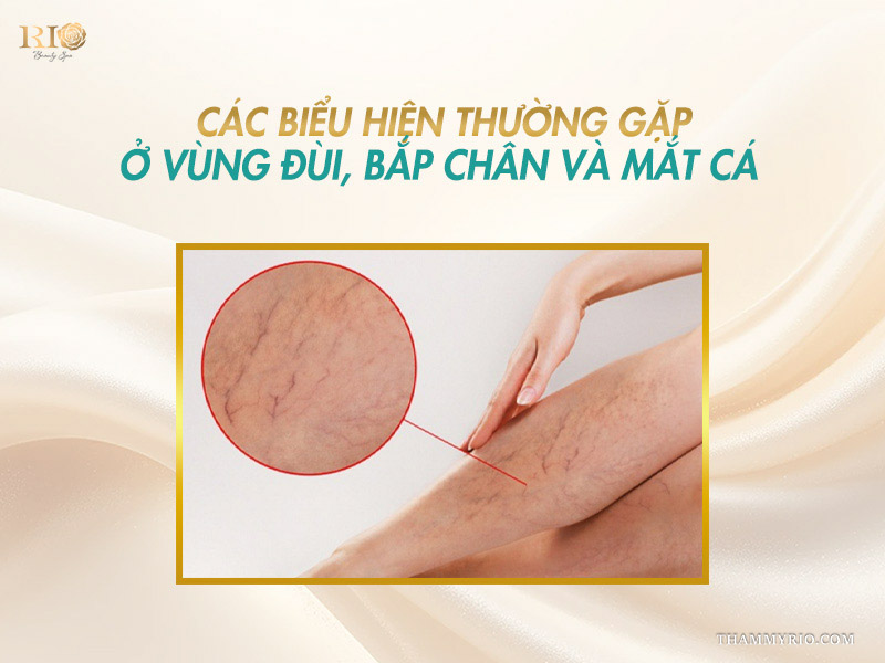 Vòng tròn phóng to các biểu hiện chân nổi nhiều mao mạch dạng mạng nhện ở vùng đùi, bắp chân và mắt cá