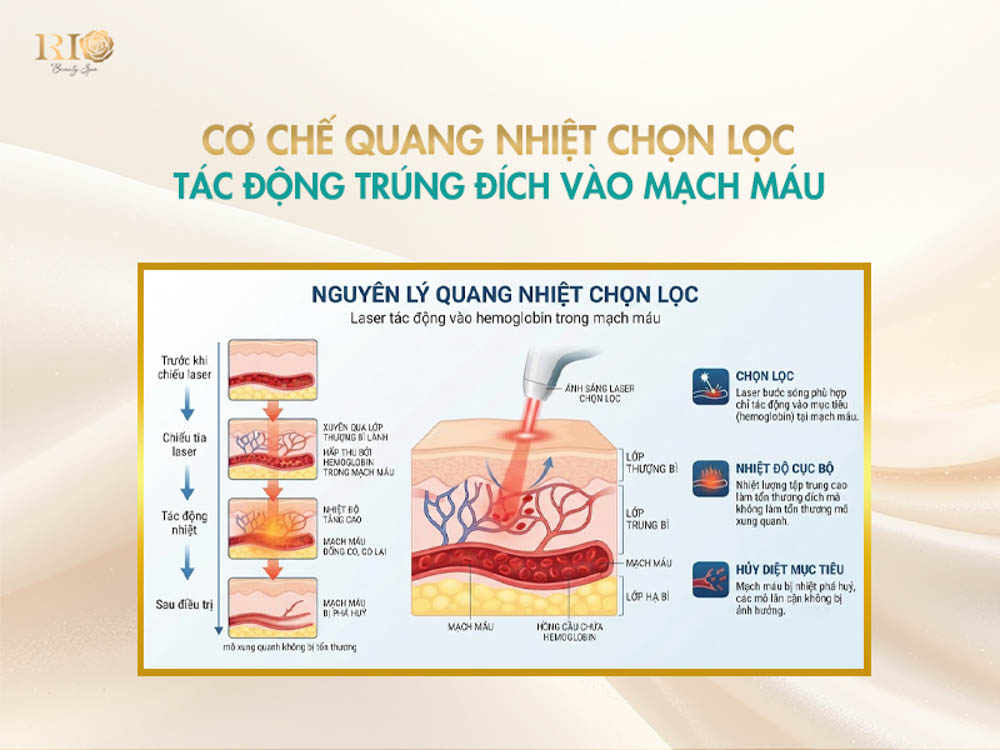 Sơ đồ nguyên lý quang nhiệt chọn lọc tác động trúng đích mạch máu của công nghệ Rio Vascular Laser System