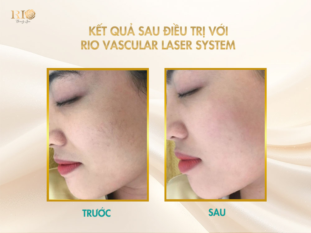 Kết quả thực tế trước và sau điều trị giãn mao mạch má bằng công nghệ Rio Vascular Laser System