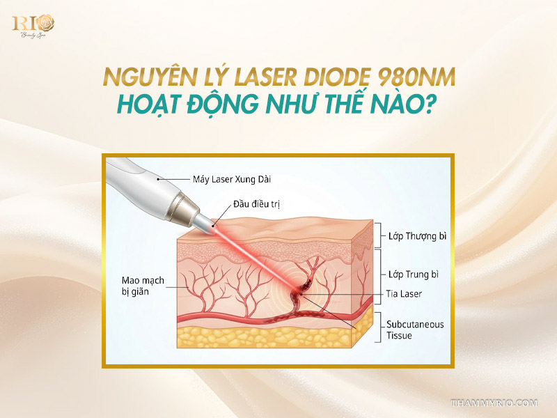 Sơ đồ cấu trúc da mô tả cơ chế tia laser quang đông mao mạch của Công nghệ Bio Vein Clear Max 980 nm