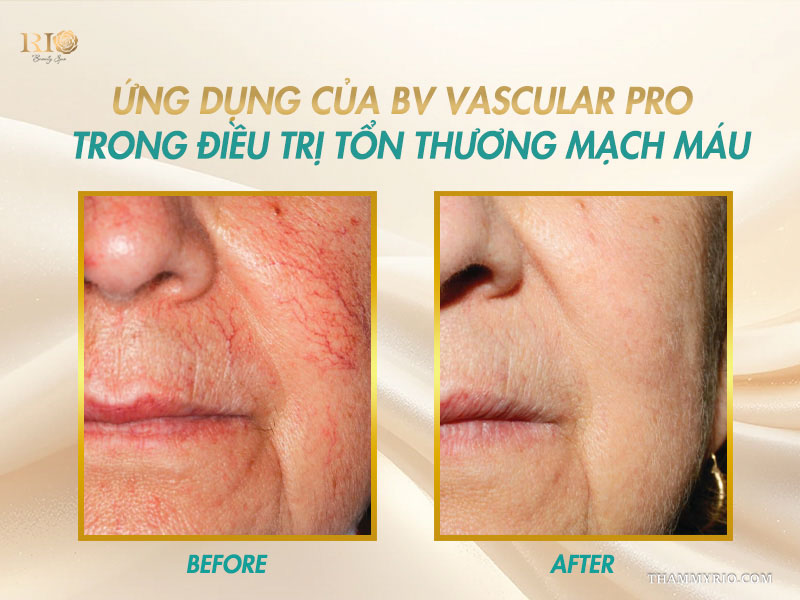 Hình ảnh Before After vùng má và khóe miệng trước và sau khi trị liệu bằng Công nghệ BV Vascular Pro 980 nm 1470 nm