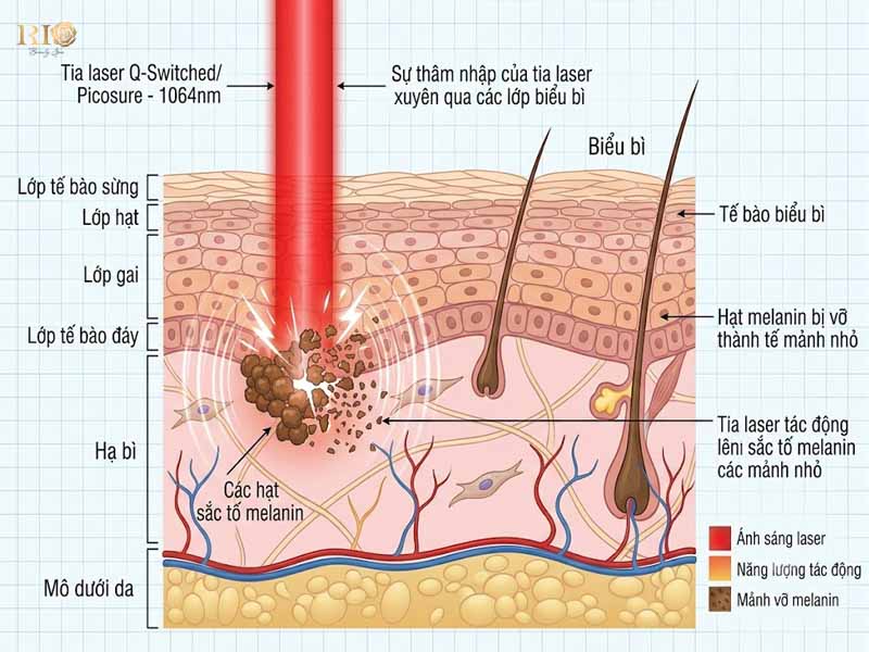 Tổ hợp công nghệ Nova Laser tác động vào sắc tố melanin trong da