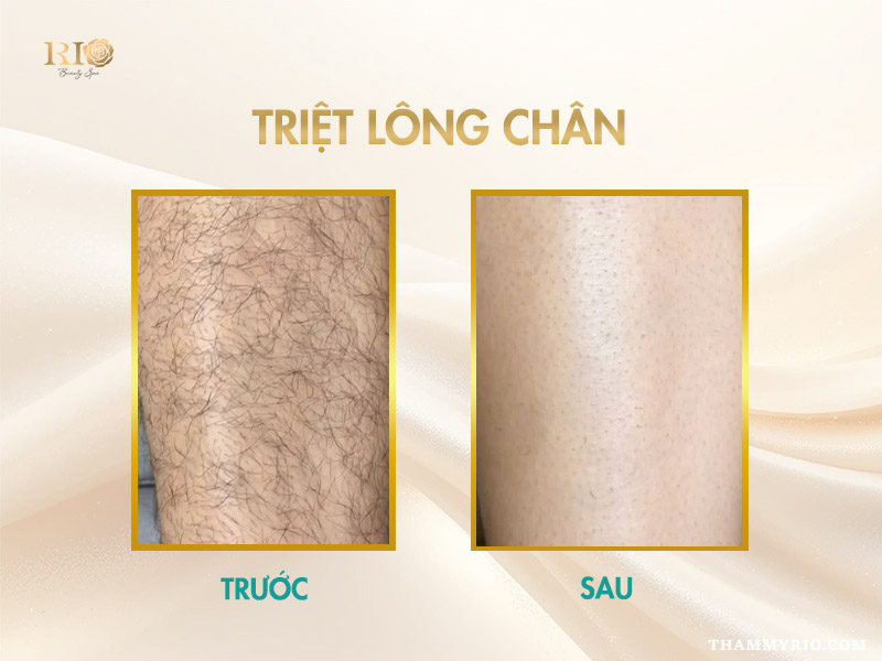 Công nghệ triệt lông Navy AI Diode Laser giúp triệt lông chân sạch an toàn tại Thẩm Mỹ Rio Beauty Clinic