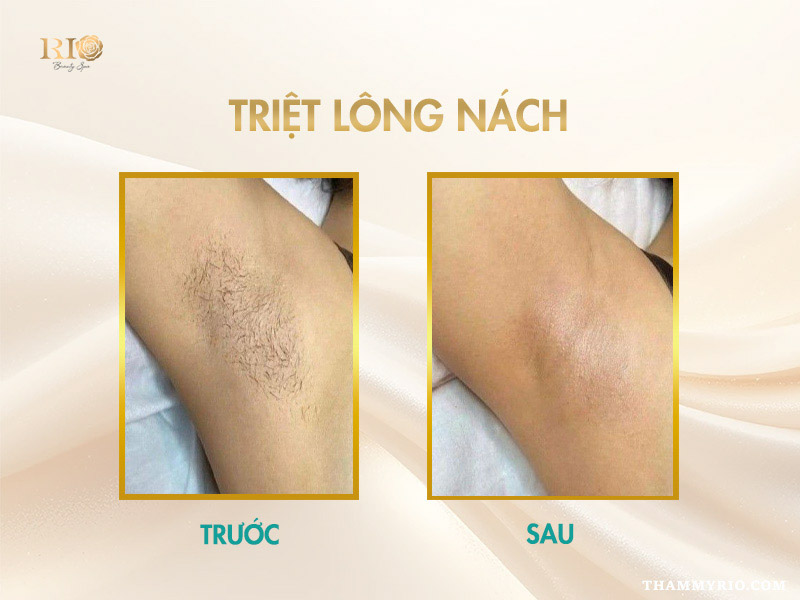 Công nghệ triệt lông Navy AI Diode Laser giúp triệt lông nách sạch an toàn tại Thẩm Mỹ Rio Beauty Clinic