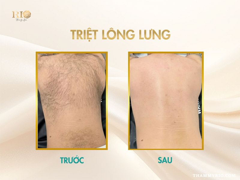 Công nghệ triệt lông Navy AI Diode Laser triệt lông lưng nam an toàn tại Thẩm Mỹ Rio Beauty Clinic