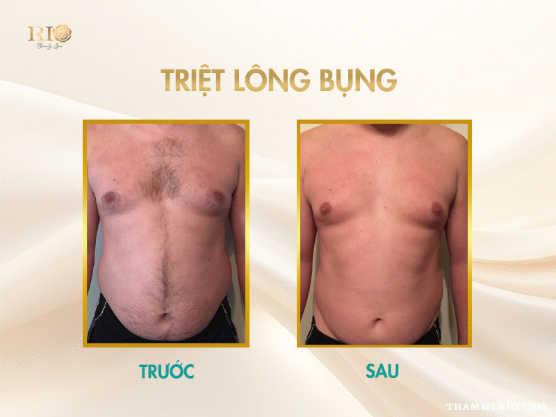 Công nghệ triệt lông Navy AI Diode Laser triệt lông ngực và bụng nam an toàn tại Thẩm Mỹ Rio Beauty Clinic