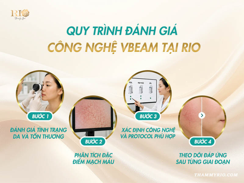 4 bước quy trình đánh giá và phác đồ điều trị mạch máu chuẩn y khoa với Công nghệ Vbeam Candela 595nm