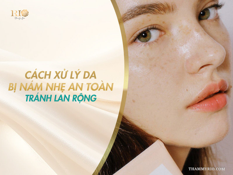 Cận cảnh gương mặt nữ người mẫu với các đốm sắc tố li ti trên banner chia sẻ cách xử lý da bị nám nhẹ