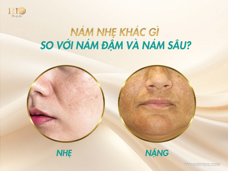 2 ô tròn đối sánh phân biệt cấp độ da bị nám nhẹ nhạt màu và tình trạng nám mảng nặng sẫm màu