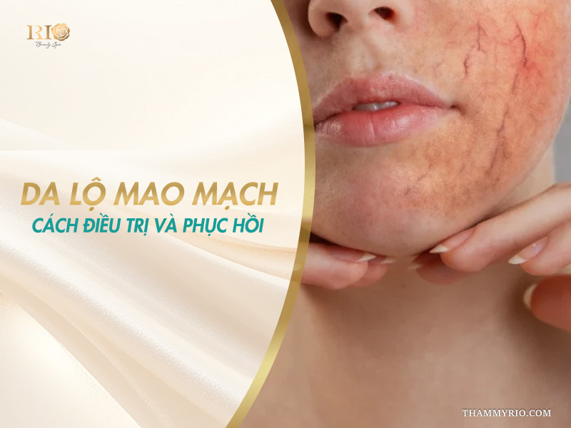 Cận cảnh vùng má và cằm ửng đỏ lộ rõ mạch máu trên banner tìm hiểu cách điều trị da lộ mao mạch