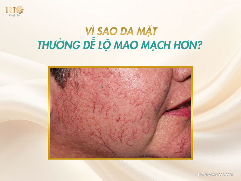 Cận cảnh vùng da má mỏng yếu nổi gân máu đỏ dày đặc giải thích nguyên nhân da lộ mao mạch