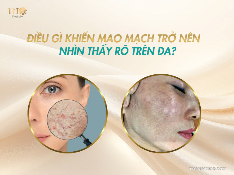 Kính lúp phóng to cấu trúc gân máu đỏ đối sánh với làn da thực tế giải thích nguyên nhân da lộ mao mạch