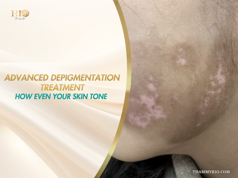 Close-up of hypopigmented and hyperpigmented patches on a client's cheek on a banner explaining advanced depigmentation treatment
