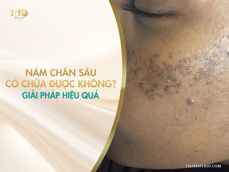 Cận cảnh làn da bị các vết đốm sẫm màu dưới mắt trên banner giải đáp thắc mắc điều trị nám chân sâu