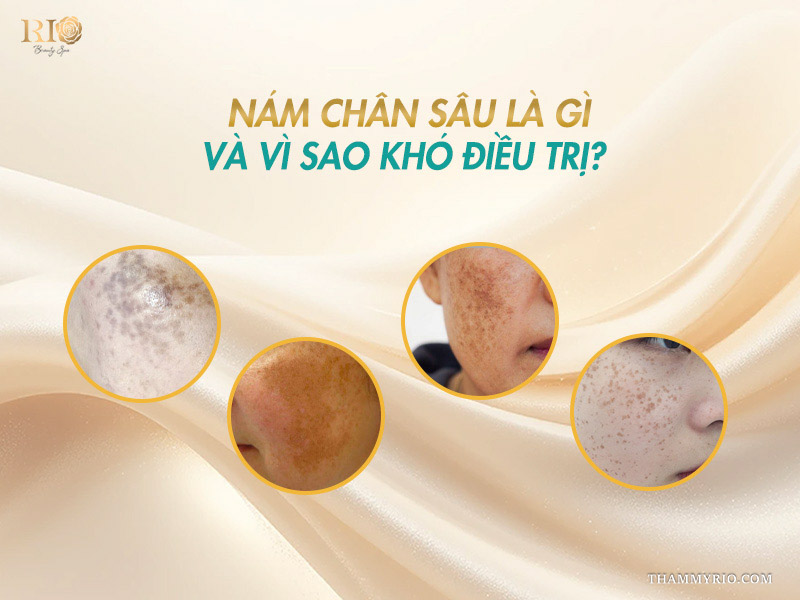 4 ô tròn minh họa các loại đốm sắc tố sâu phân bố diện rộng trên banner phân tích điều trị nám chân sâu