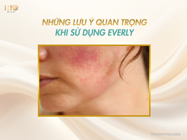 Cận cảnh nền da má bị ửng đỏ sau liệu trình cần sử dụng sản phẩm Everly sau laser giãn mao mạch