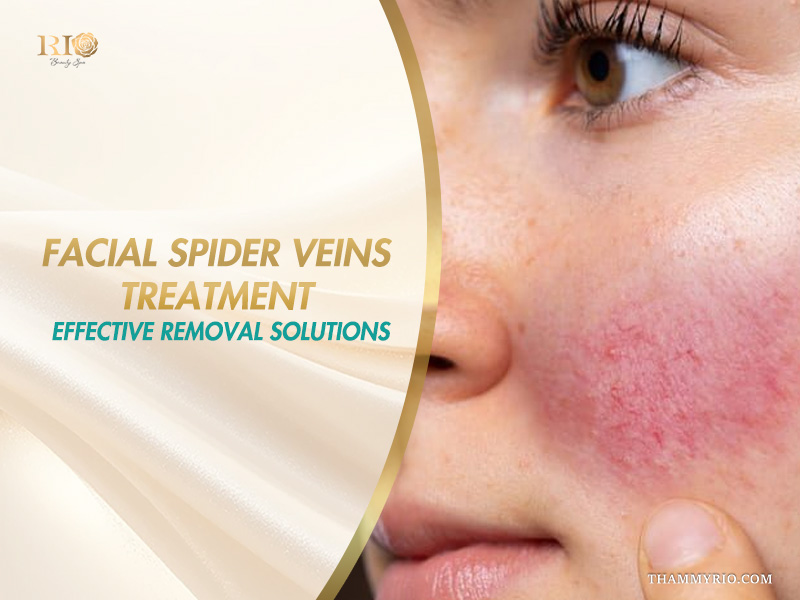 Close-up of diffused redness and broken capillaries on a cheek on a banner explaining facial spider veins treatment solutions