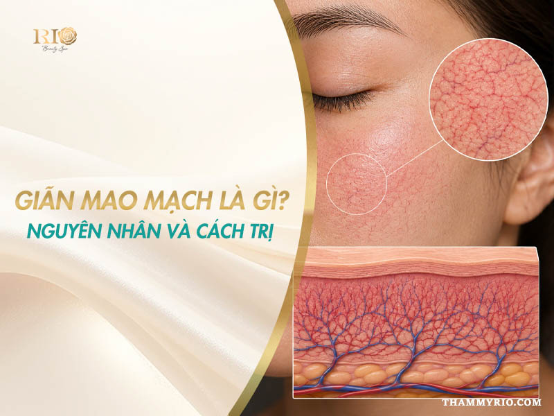 Kiến thức tổng quan giãn mao mạch là gì, nguyên nhân và cách trị chuẩn y khoa tại Thẩm mỹ Rio Beauty Clinic.