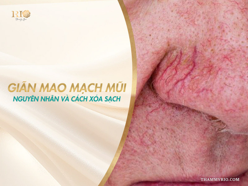 Hình ảnh cận cảnh tình trạng giãn mao mạch mũi cùng thông tin nguyên nhân và cách xóa sạch hiệu quả tại Thẩm mỹ Rio Beauty Clinic.