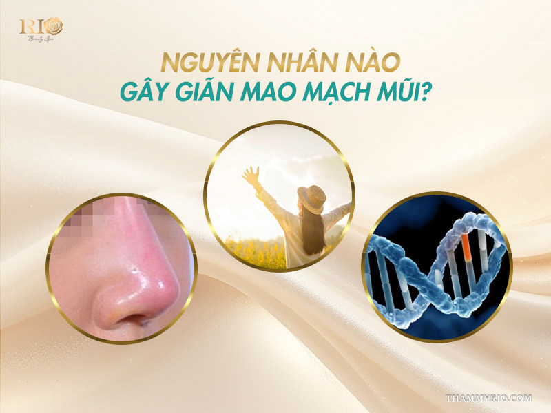 Minh họa các nguyên nhân chính gây ra tình trạng giãn mao mạch mũi theo chia sẻ từ chuyên gia Thẩm mỹ Rio Beauty Clinic.