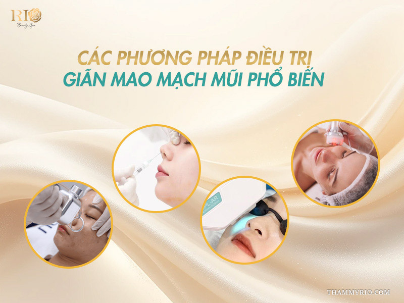 Tổng hợp các phương pháp điều trị giãn mao mạch mũi phổ biến và hiện đại tại Thẩm mỹ Rio Beauty Clinic.
