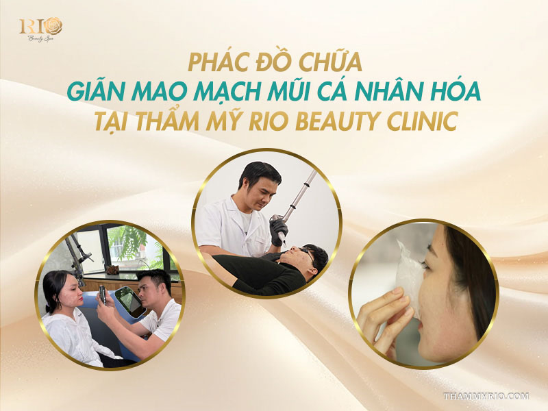 Phác đồ chữa giãn mao mạch mũi cá nhân hóa độc quyền tại Thẩm mỹ Rio Beauty Clinic.