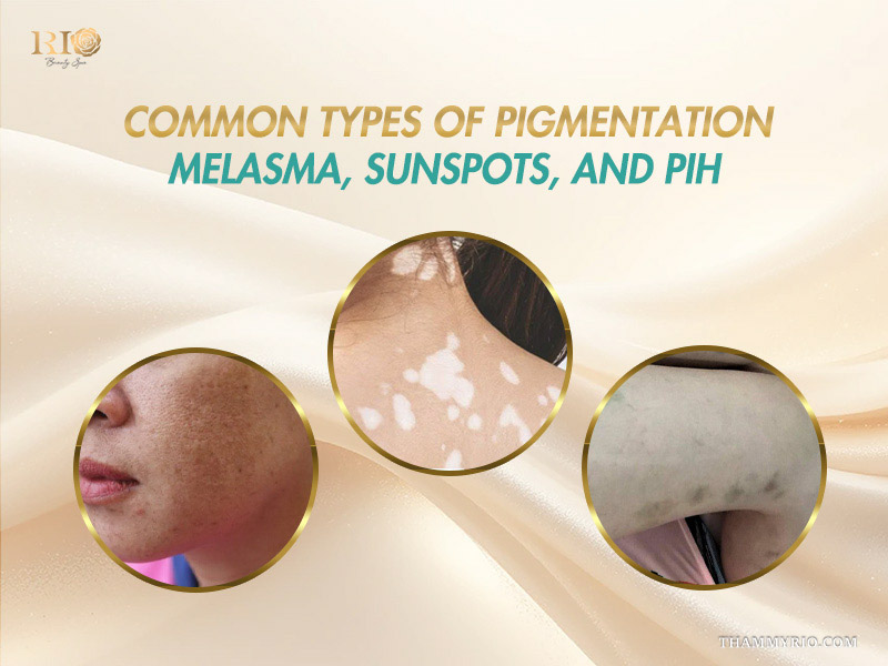 Three circular photos identifying melasma, vitiligo white spots, and deep body discoloration as common types of skin pigmentation