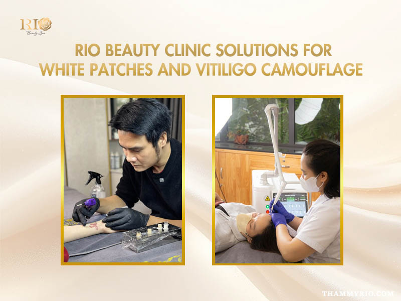 Rio Beauty Clinic solutions for white patches and vitiligo camouflage