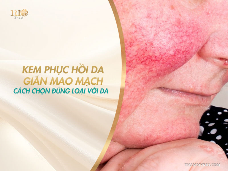 Cận cảnh má ửng đỏ lộ rõ gân máu trên banner hướng dẫn chọn kem phục hồi da giãn mao mạch đúng cách